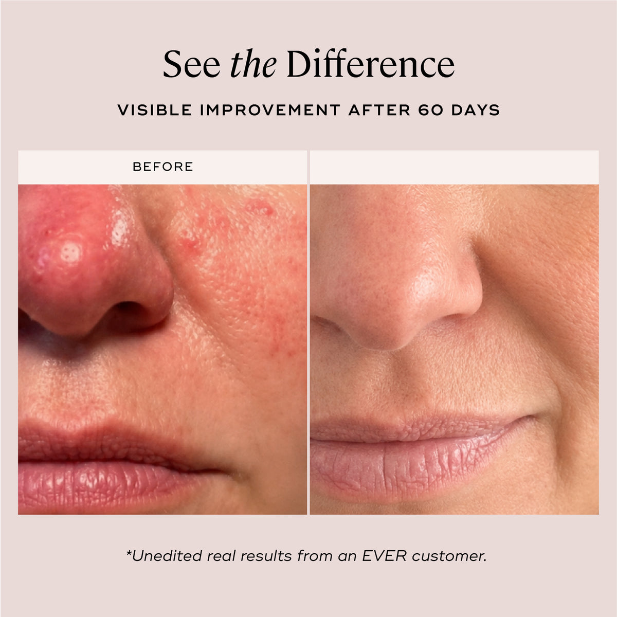 EVER Skincare Exfoliant REVEAL Biomimetic Peel Pads